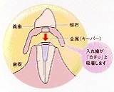 磁性アタッチメント （磁石の入れ歯です）