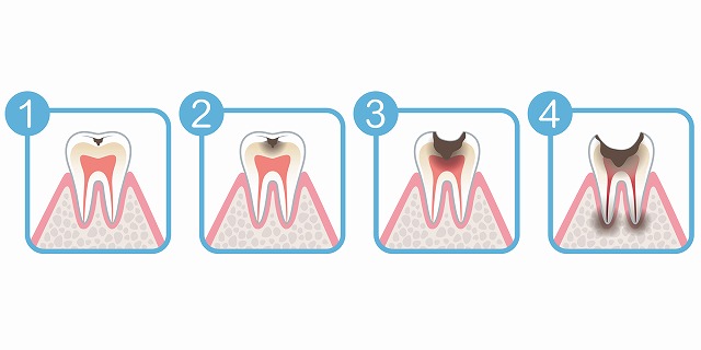 虫歯の進行